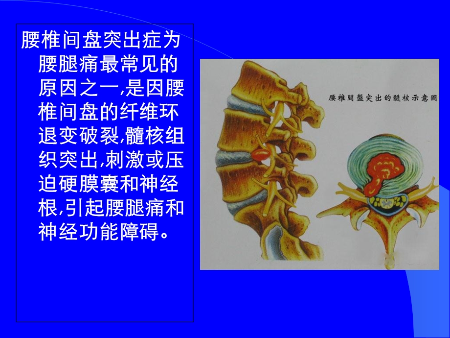 腰椎间盘突出症中医治疗.ppt_第3页