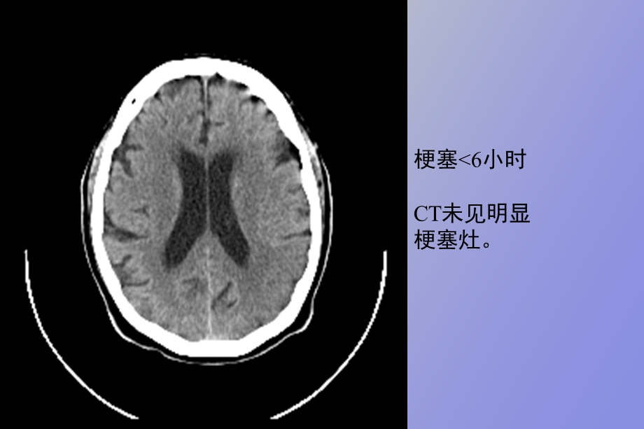 脑栓塞护理查房.ppt_第3页