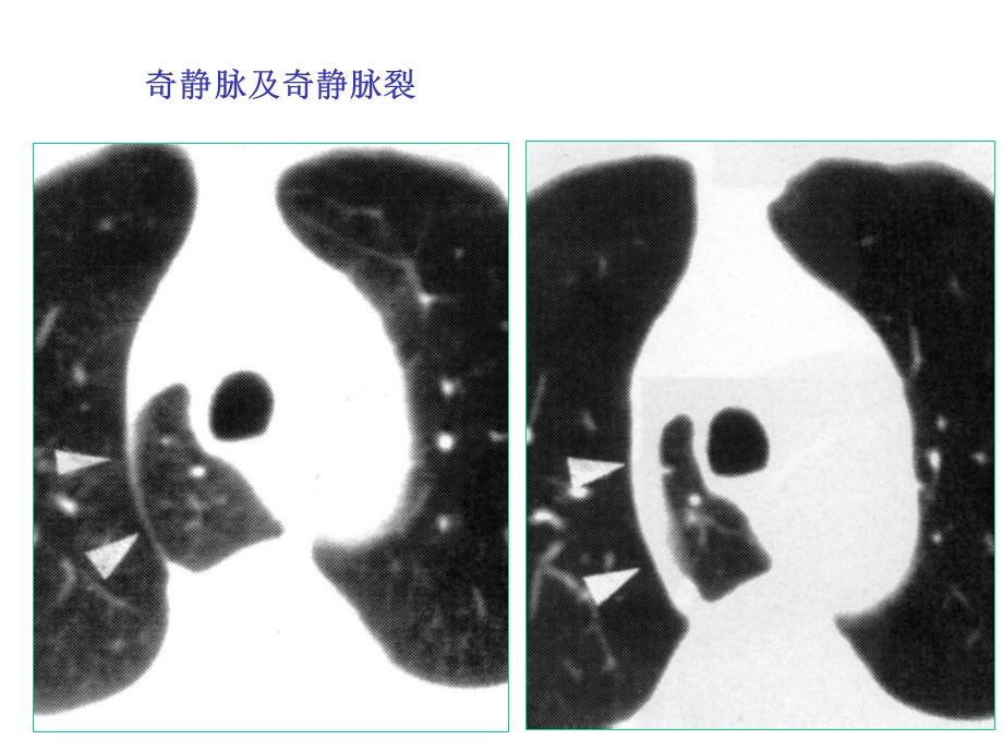 肺囊肿和支气管扩张的麻醉管理.ppt_第2页