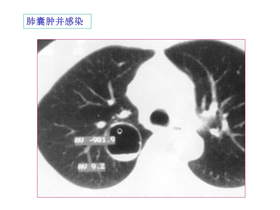 肺囊肿和支气管扩张的麻醉管理.ppt_第3页