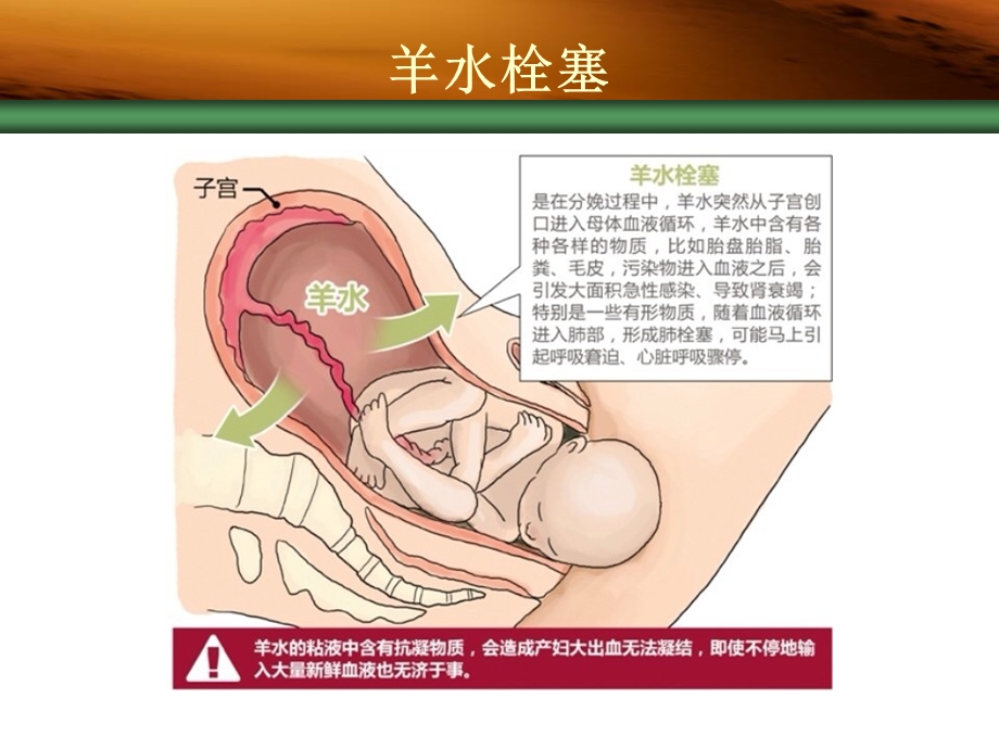 羊水栓塞的早期识别与诊治.ppt_第3页