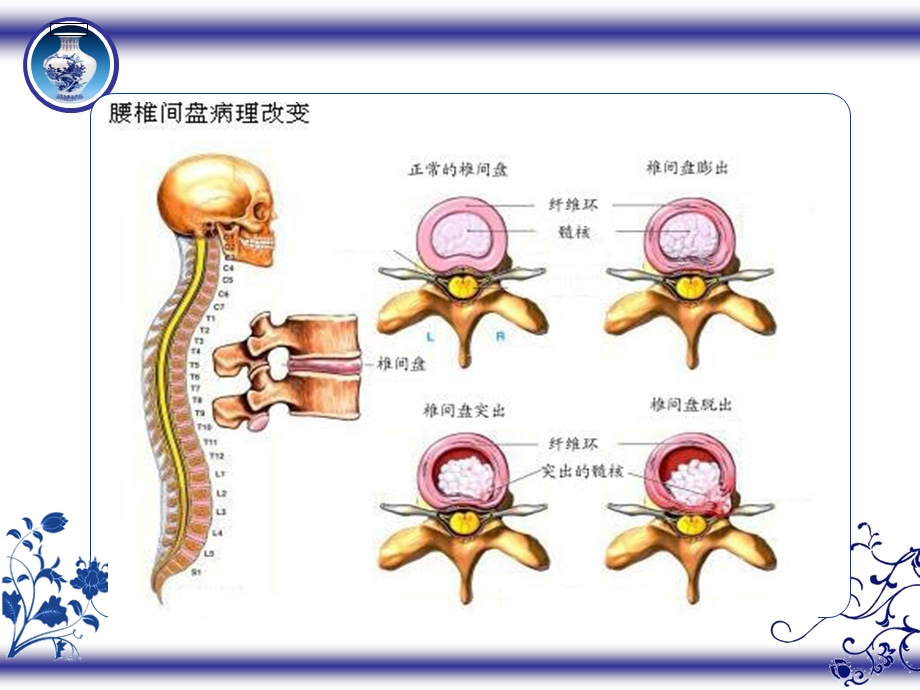 腰椎间盘突出症的护.ppt_第3页