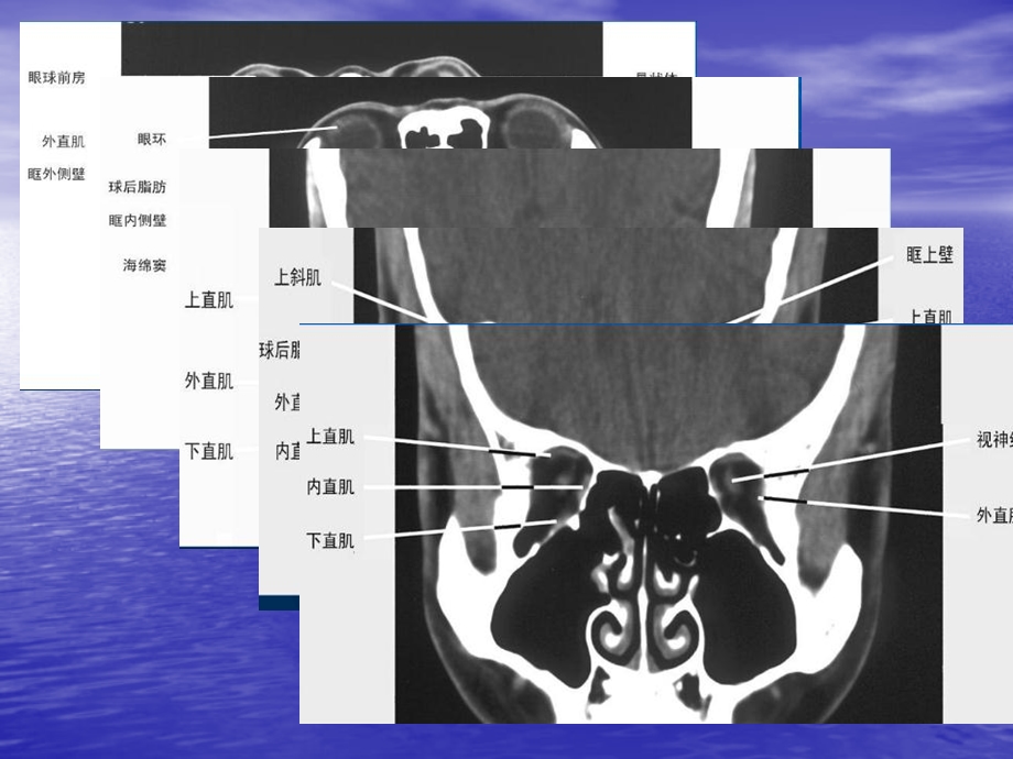 眼眶常见病变后处理技术.ppt_第3页