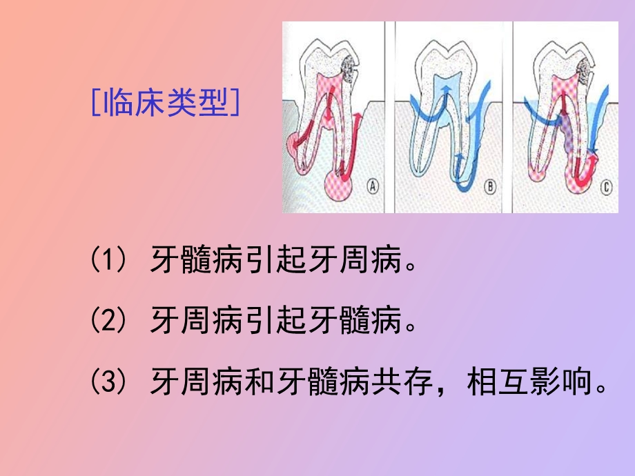 牙周炎伴发病变牙周病治疗.ppt_第3页