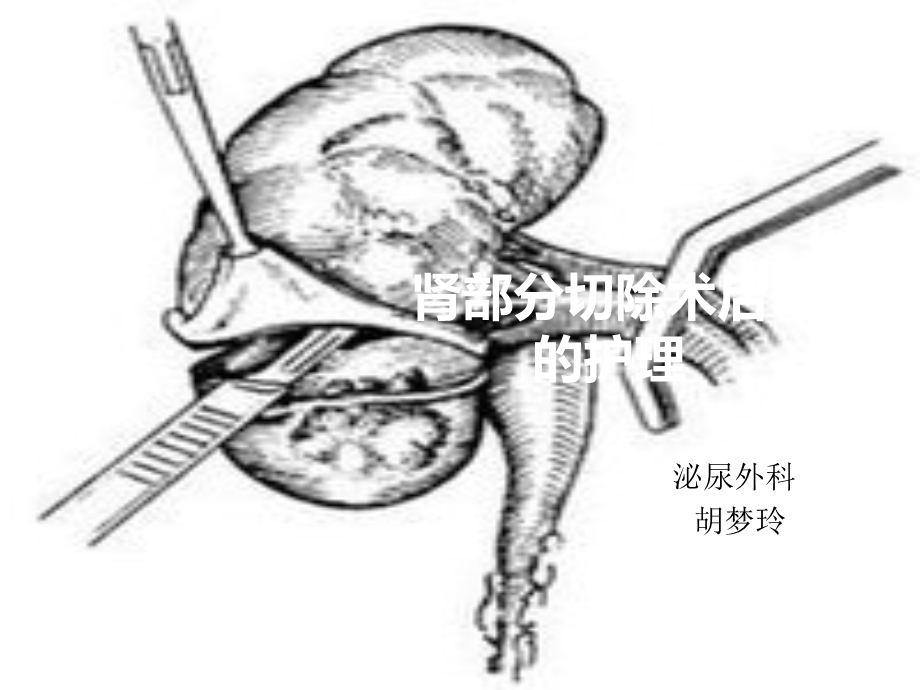 肾部分切除术后护理.ppt_第1页