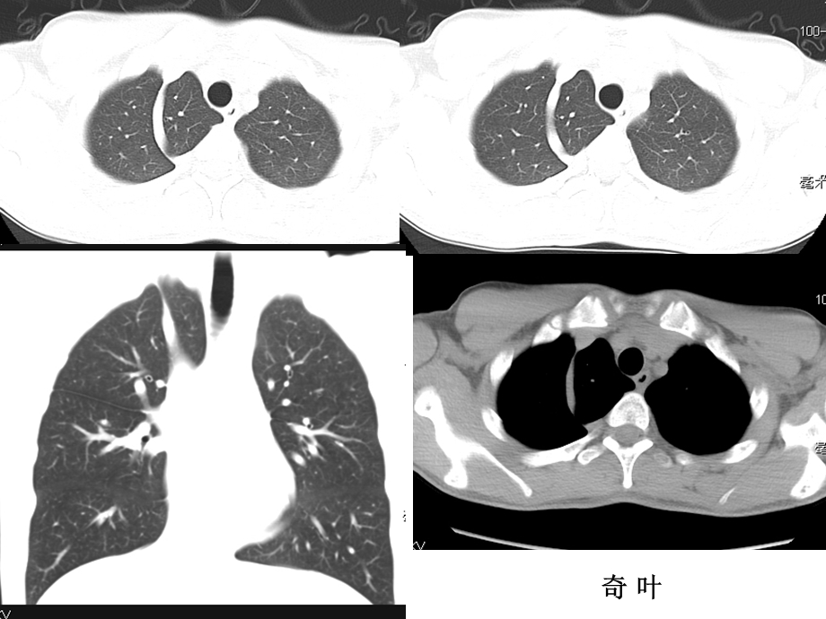 呼吸系统及纵膈CT图片.ppt_第2页