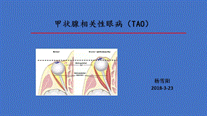 甲状腺相关性眼病.ppt