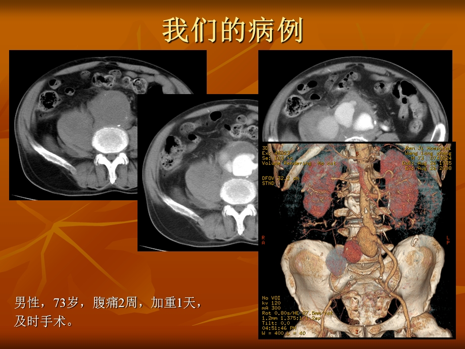 腹主动脉瘤破裂及先兆破裂的CT表现.ppt_第2页