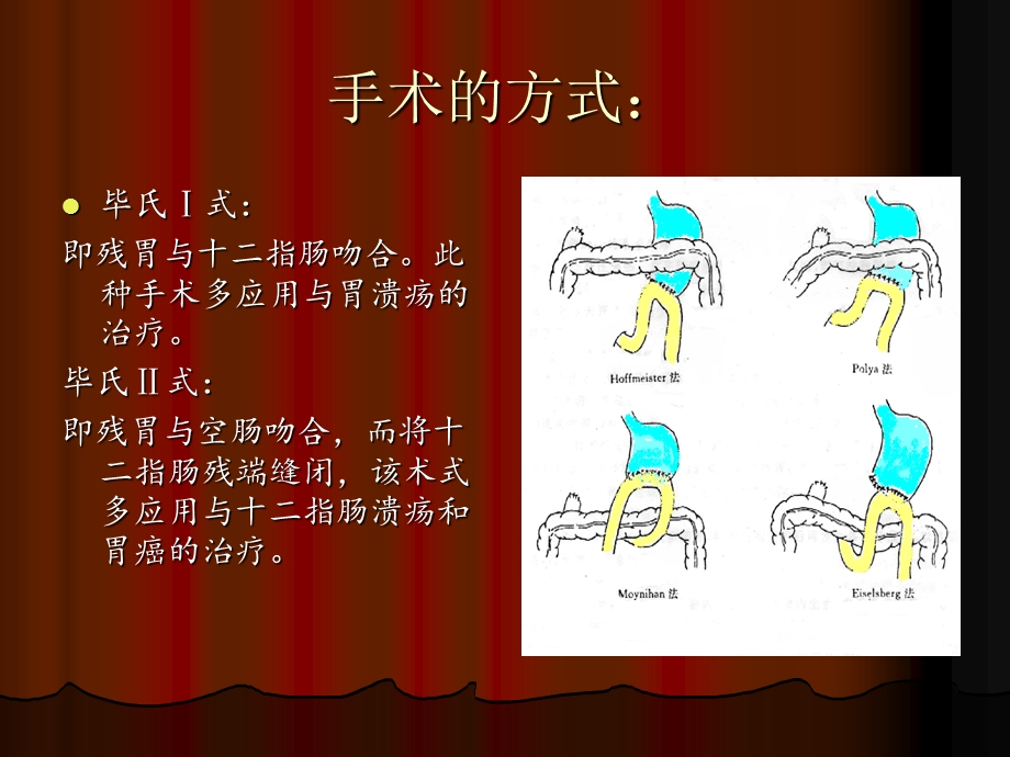 胃大部切除术后的护理.ppt_第3页