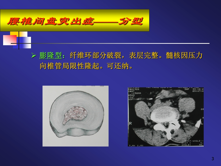 腰椎间盘突出症病人的护理PPT课件.ppt_第3页