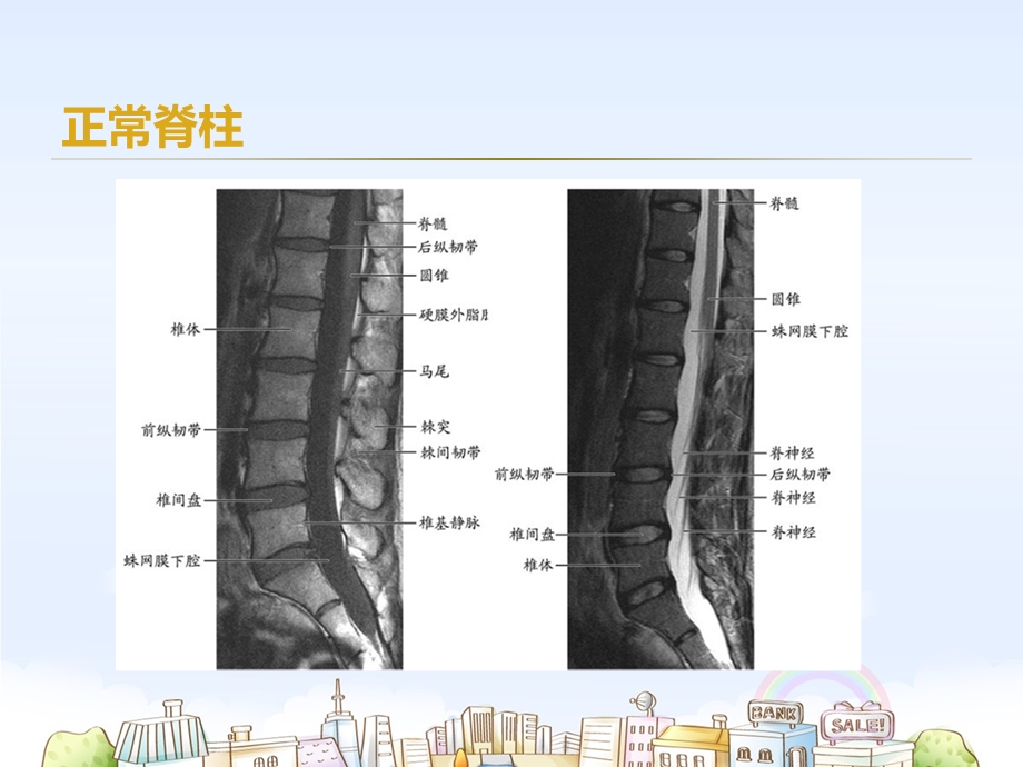 腰椎间盘突出症术后常见并发症观察及护理.ppt_第3页