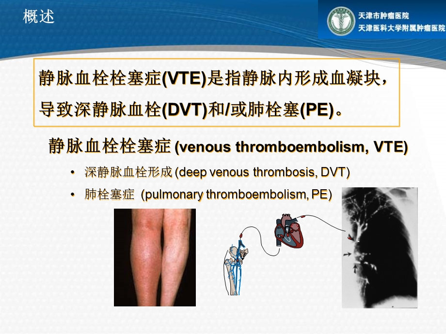 肿瘤相关VTE的抗凝治疗.ppt_第2页