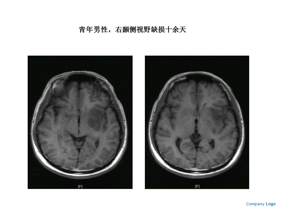 肿瘤样脱髓鞘病变课件.ppt_第2页