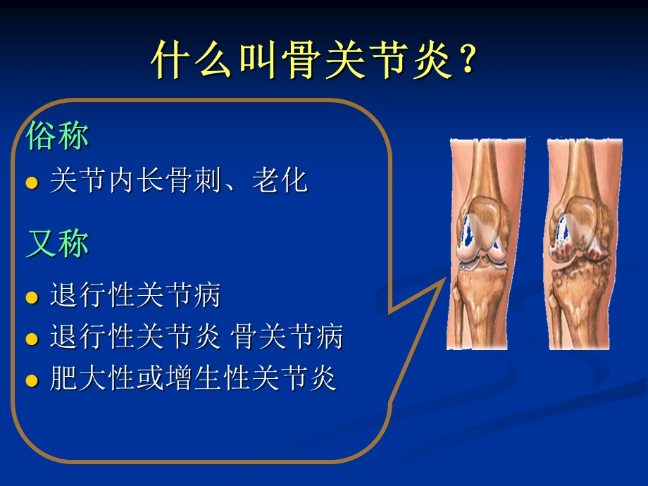 膝关节骨性关节炎的阶梯治疗.ppt_第3页