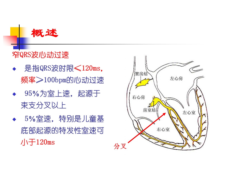 窄QRS波心动过速概述、分类和鉴别诊断.ppt_第2页