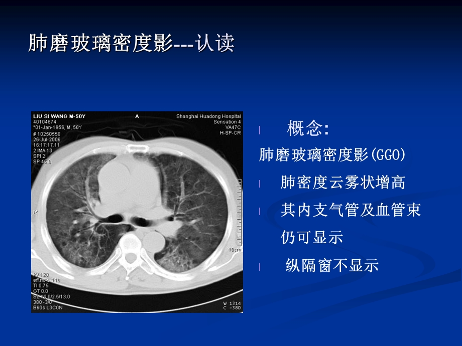 肺弥漫性磨玻璃密度影的影像分析.ppt_第2页