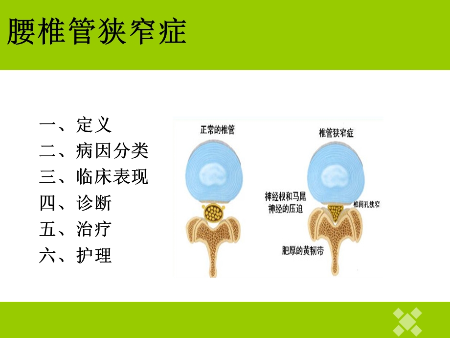 腰椎管狭窄症护理查房.ppt_第3页