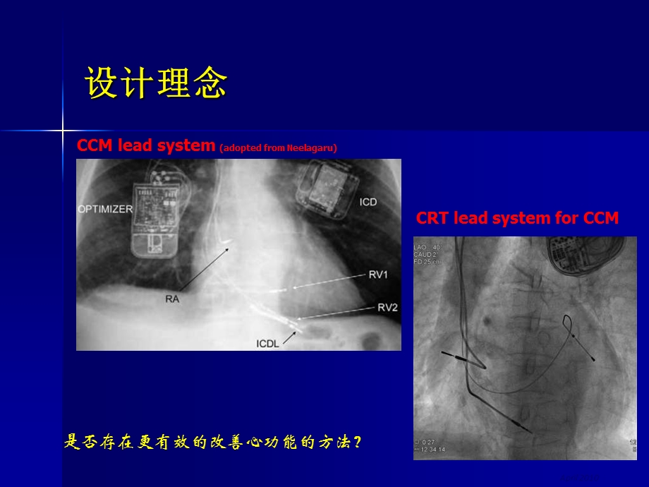 通过CRTD系统心脏收缩力调制CCM的临床研究.ppt_第3页