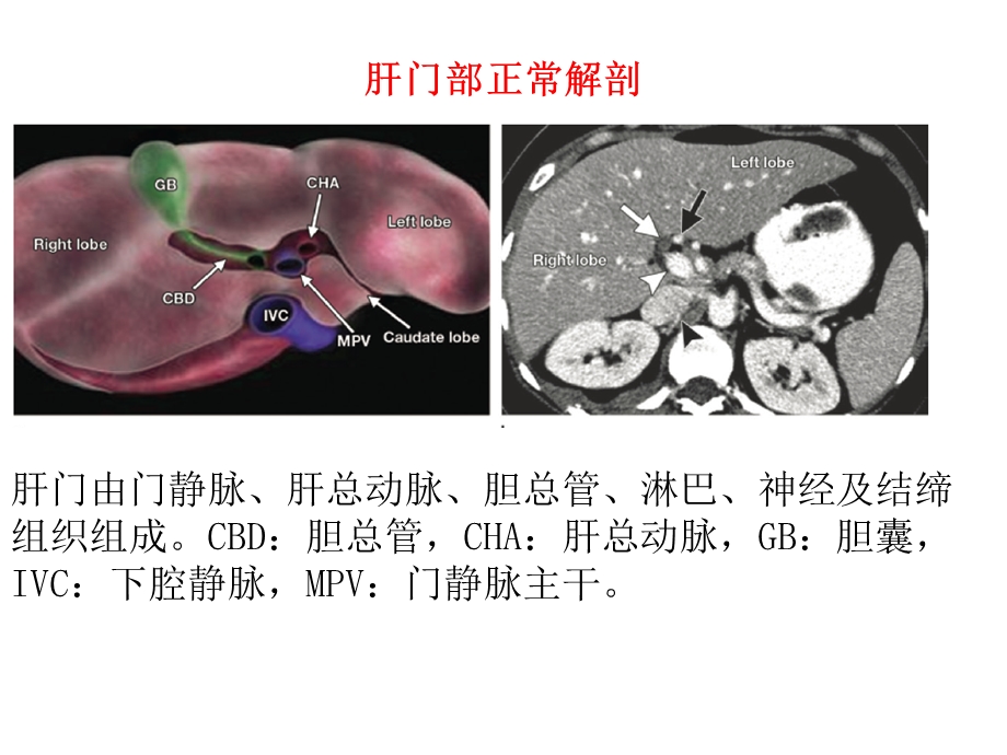肝门部病变影像学表现.ppt_第2页
