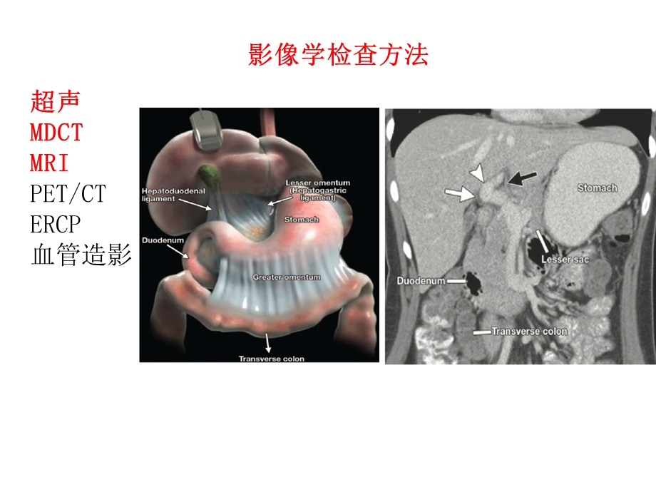 肝门部病变影像学表现.ppt_第3页