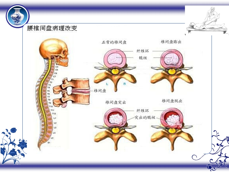 腰椎间盘突出症的中医护理.ppt_第3页