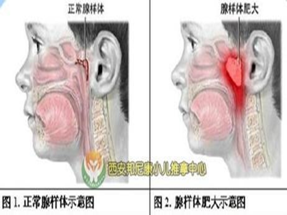 腺样体肥大手术患者的护理.ppt_第3页