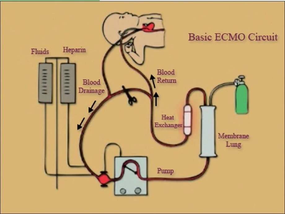 ecmo呼吸循环衰竭的应用课件 ppt课件.ppt_第3页