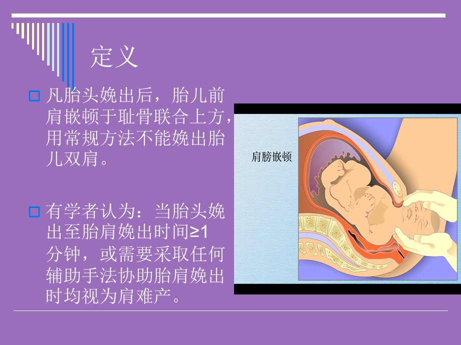 肩难产紧急处理课件.ppt_第3页