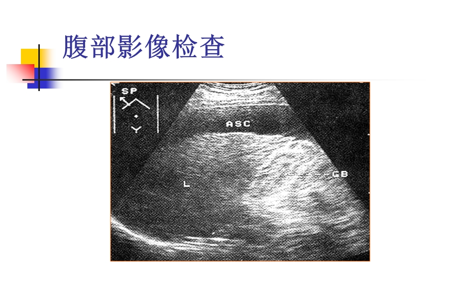 腹水的诊断以鉴别诊断.ppt_第3页