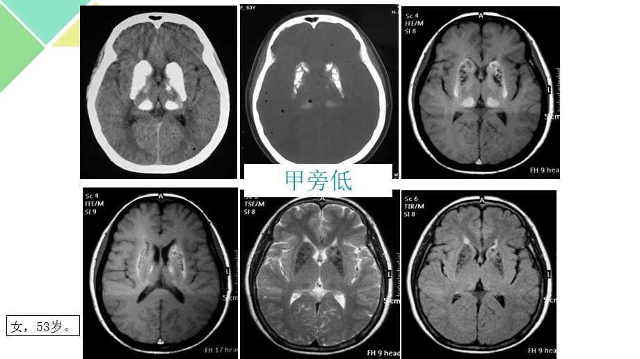 甲状旁腺功能减退症.ppt_第2页