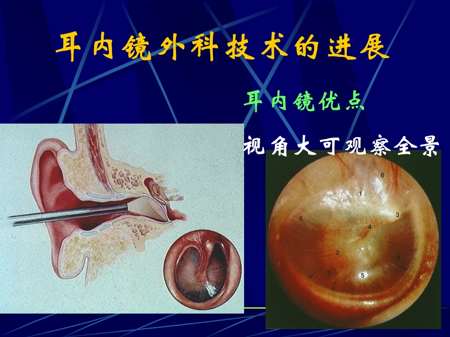 耳内镜微创外科技术.ppt_第3页