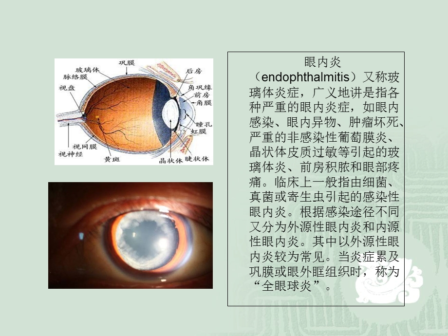 眼内炎患者的疾病.ppt_第2页