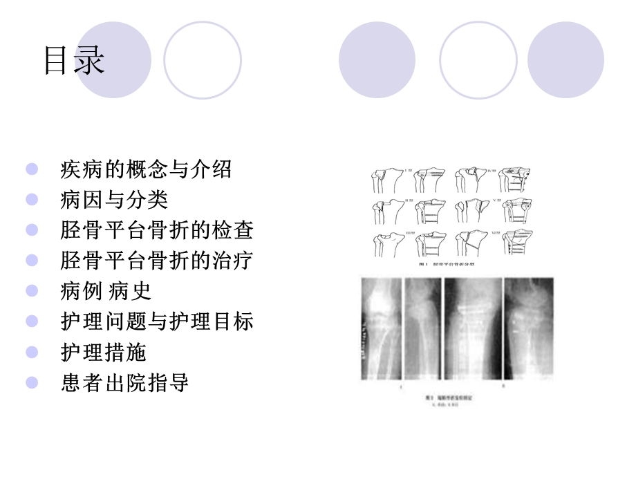 胫骨平台骨折的护理查房.ppt_第2页