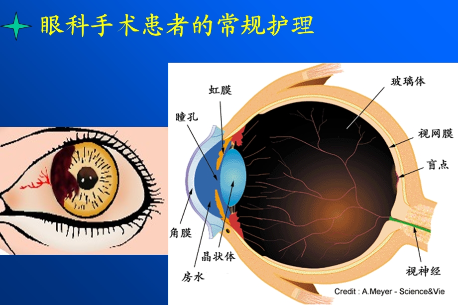 眼外伤及眼科手术护理.ppt_第1页