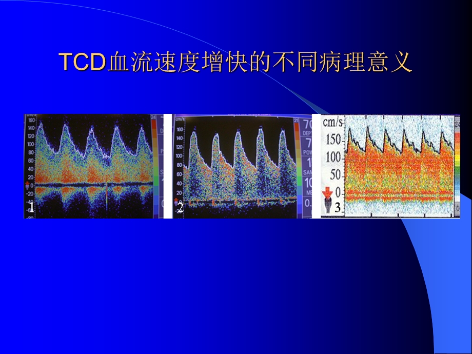 脑血流速度增快或减慢的病理意义.ppt_第3页