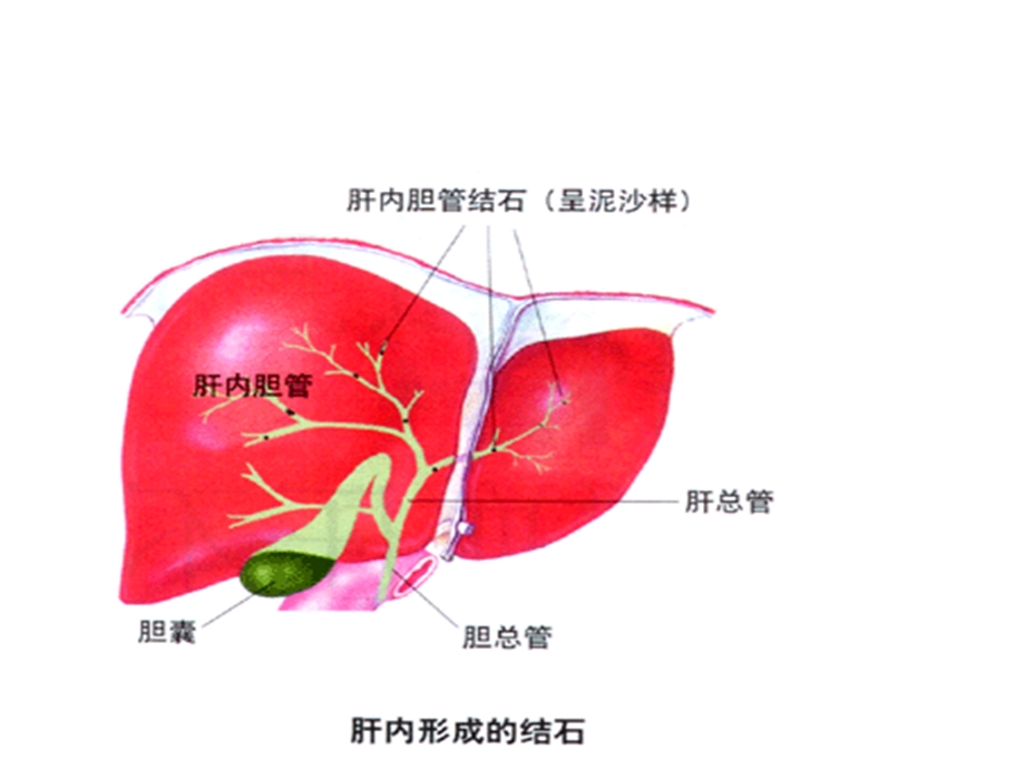 肝内外胆管结石病人的护理.ppt_第3页