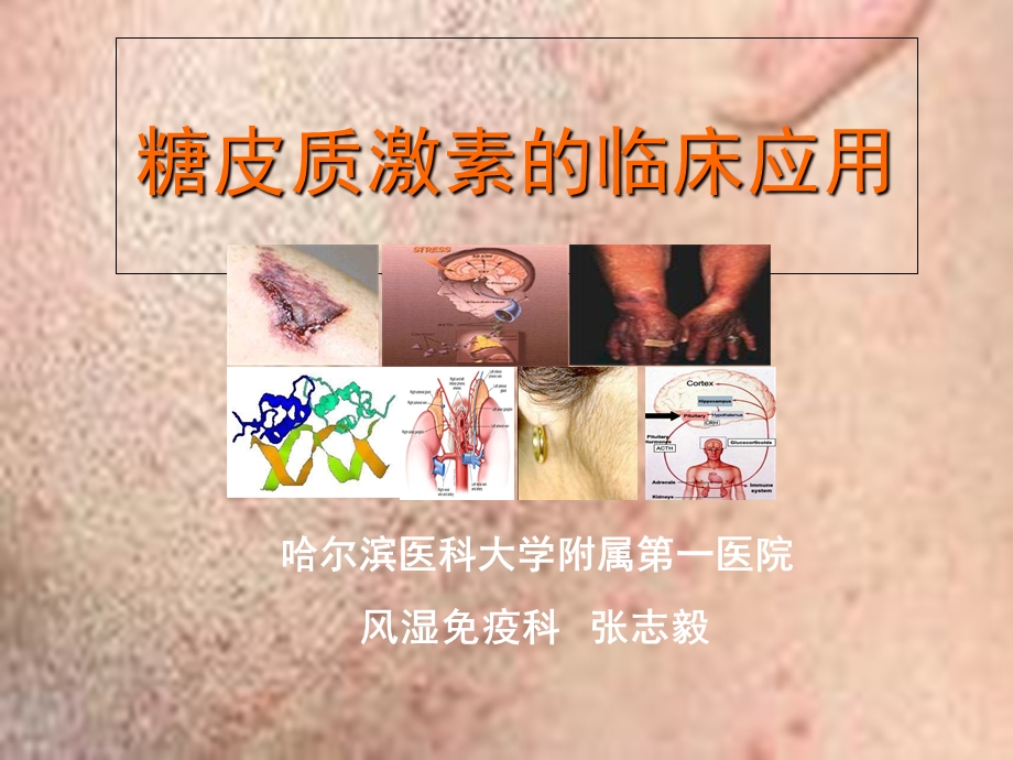 糖皮质激素的临床应用.ppt_第1页