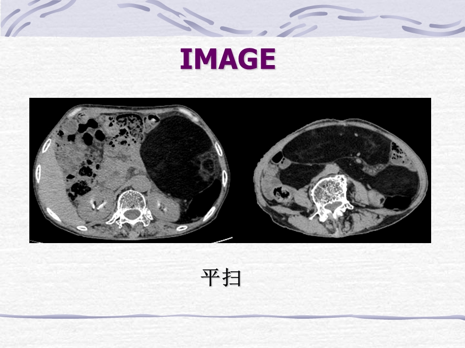 脂肪肉瘤一例CT表现.ppt_第2页