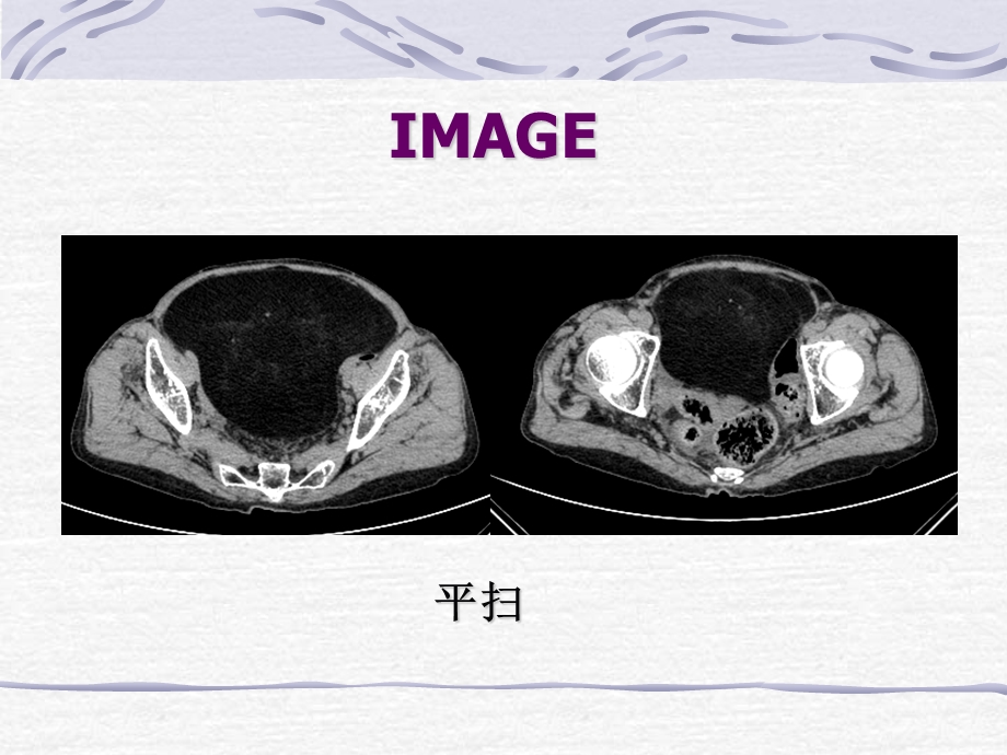 脂肪肉瘤一例CT表现.ppt_第3页