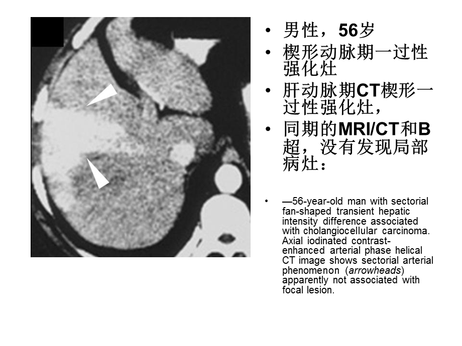 肝脏动脉期一过性强化灶.ppt_第3页