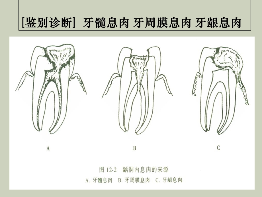 牙髓病分论、根尖周病分论.ppt_第3页