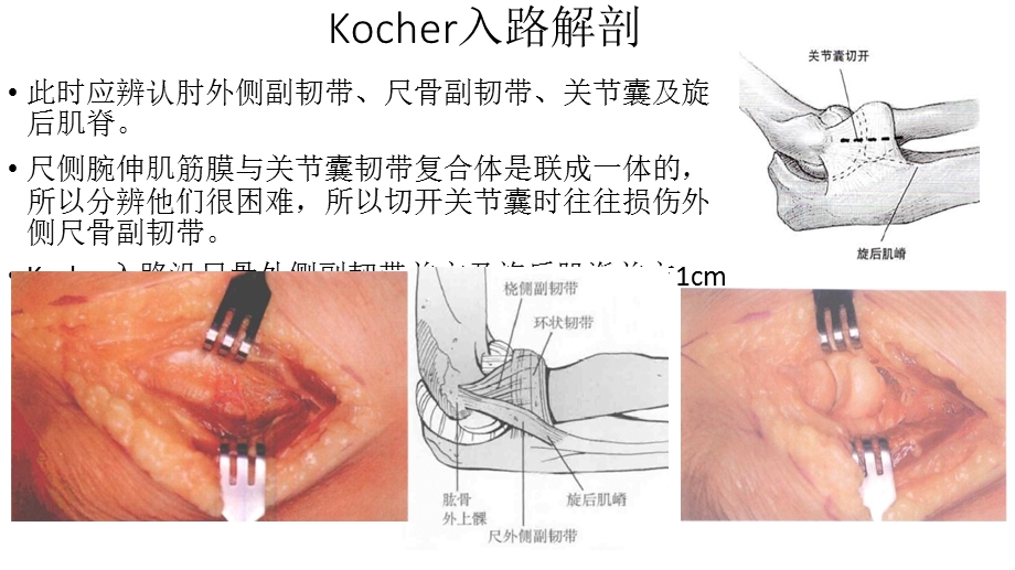 肘关节外侧入路解剖.ppt_第3页