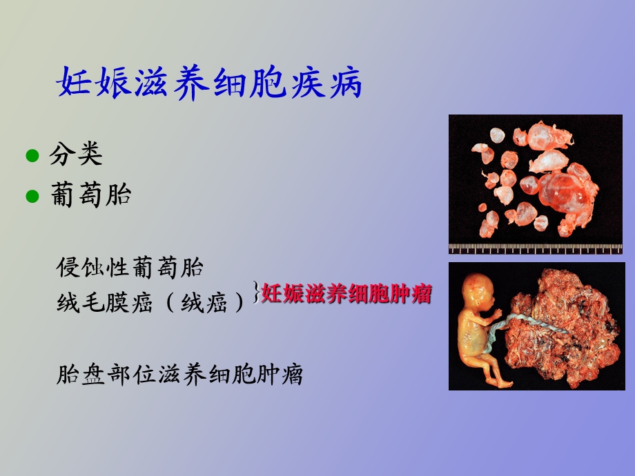 滋养细胞疾病病人的护理.ppt_第3页