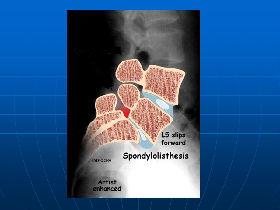 腰椎滑脱症诊断治疗.ppt_第3页