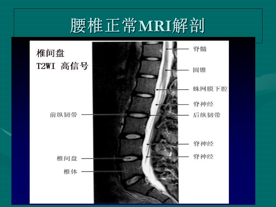 腰椎间盘的MRI诊断.ppt_第2页