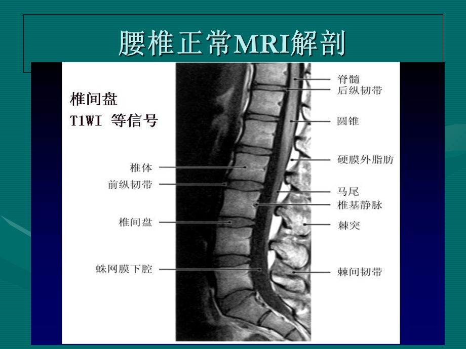 腰椎间盘的MRI诊断.ppt_第3页