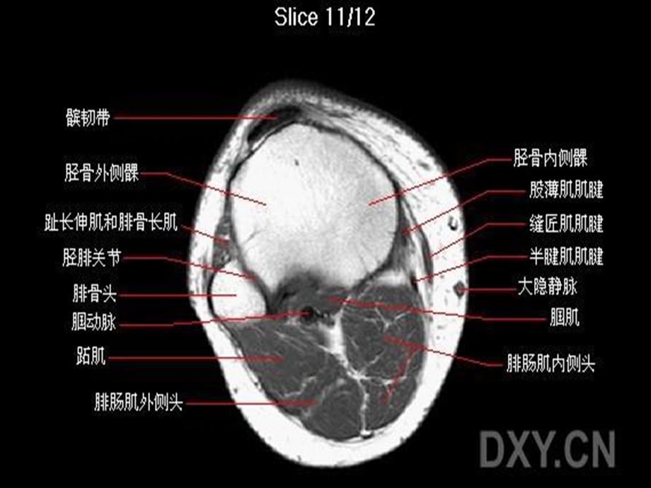 膝关节核磁共振.ppt_第3页