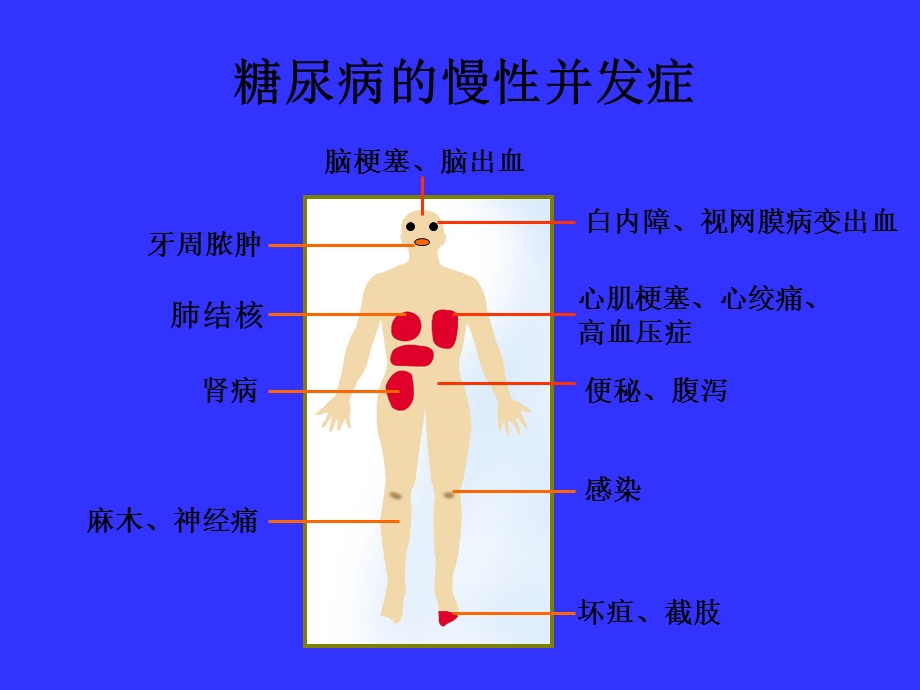 糖尿病慢性并发症.ppt_第3页