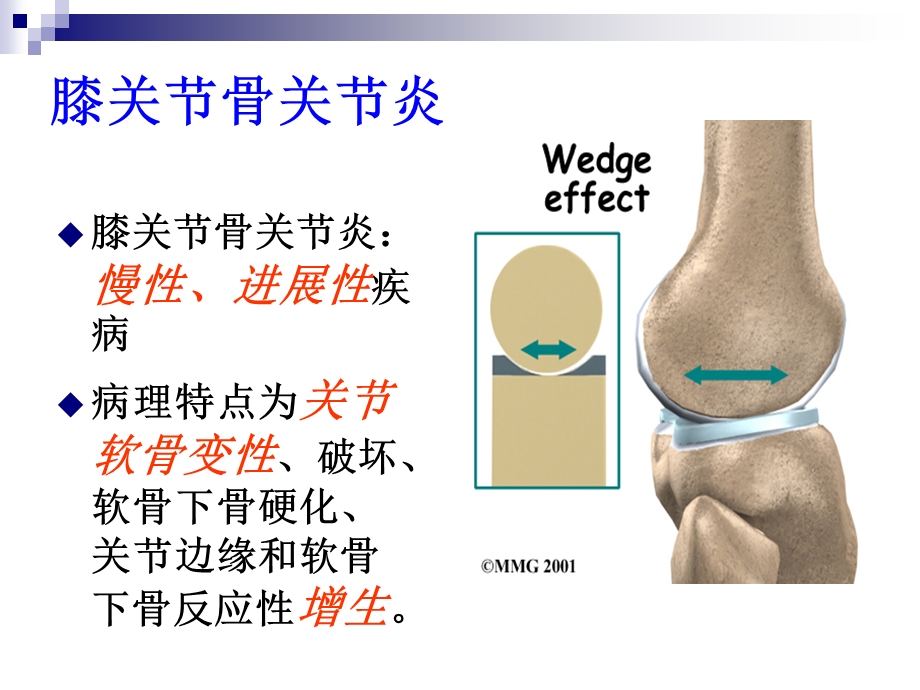 膝骨关节炎的防治.ppt_第2页