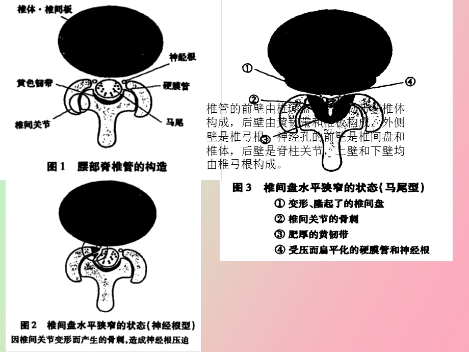 腰椎管狭窄症.ppt_第3页